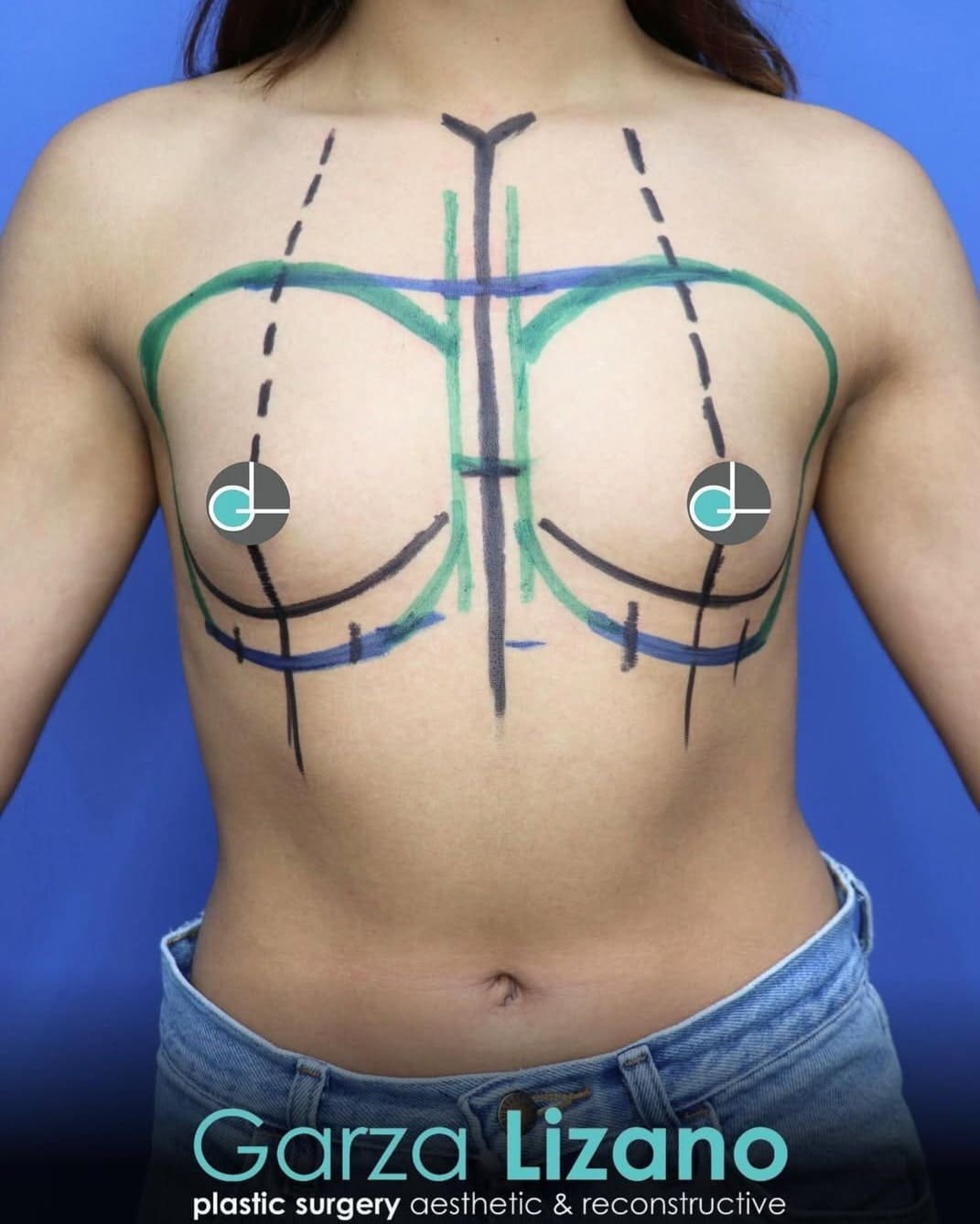 Aumento de Busto Monterrey. Dr Garza Lizano. Cirujano Plastico en Monterrey (9)