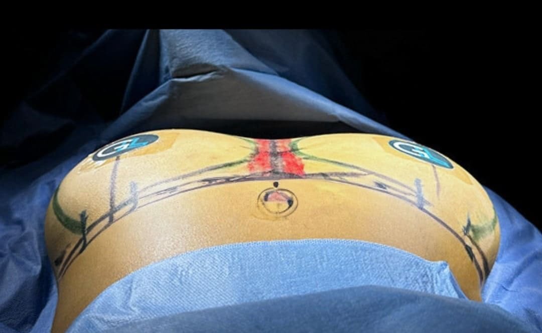 Aumento de Busto Monterrey. Dr Garza Lizano. Cirujano Plastico en Monterrey Mexico (1)