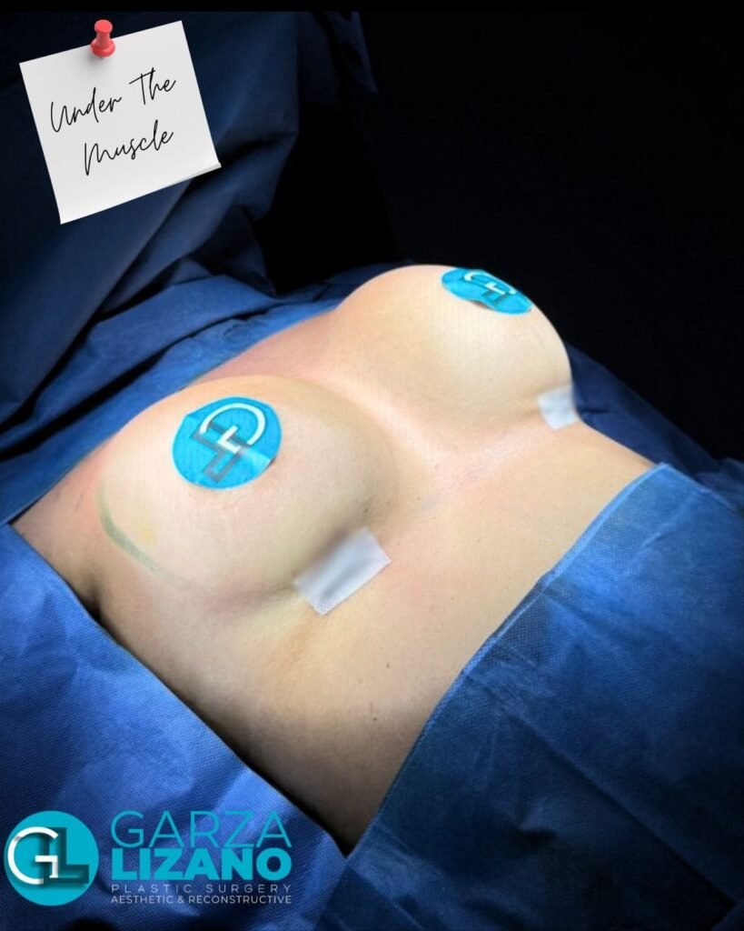 Aumento de Busto Monterrey. Dr Garza Lizano. Cirujano Plastico en Monterrey Mexico (1)