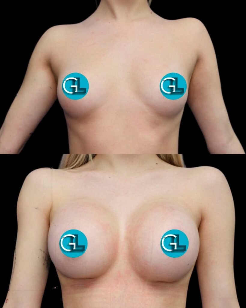 Aumento de Busto Monterrey. Dr Garza Lizano. Cirujano Plastico en Monterrey Mexico (2)