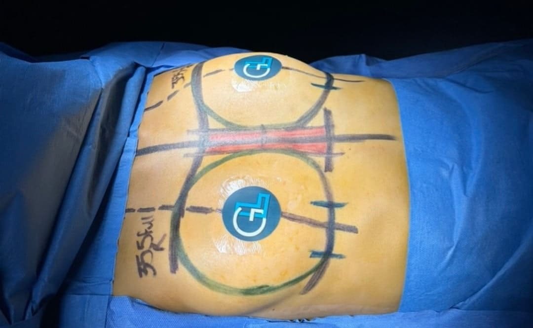 Aumento de Busto Monterrey. Dr Garza Lizano. Cirujano Plastico en Monterrey Mexico (3)