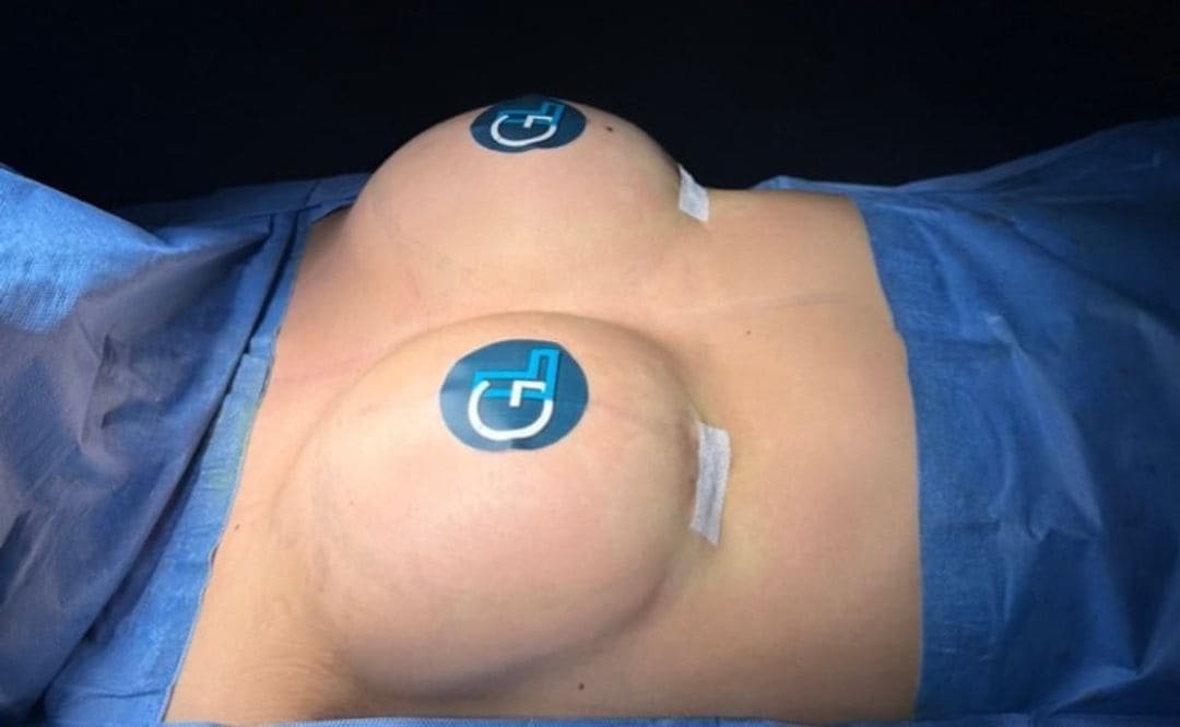 Aumento de Busto Monterrey. Dr Garza Lizano. Cirujano Plastico en Monterrey Mexico (4)