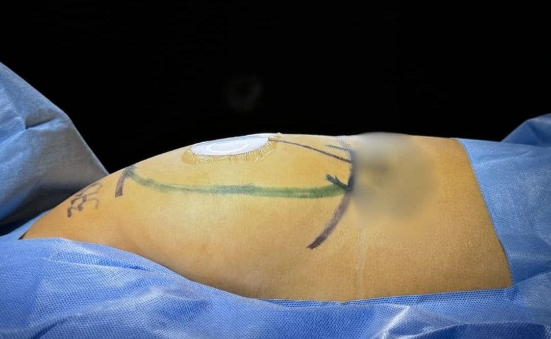 Aumento de Busto Monterrey. Dr Garza Lizano. Cirujano Plastico en Monterrey Mexico (5)