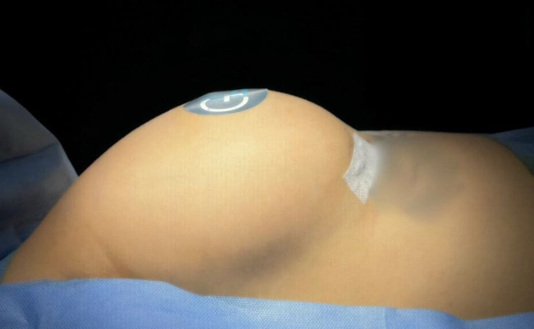 Aumento de Busto Monterrey. Dr Garza Lizano. Cirujano Plastico en Monterrey Mexico (6)