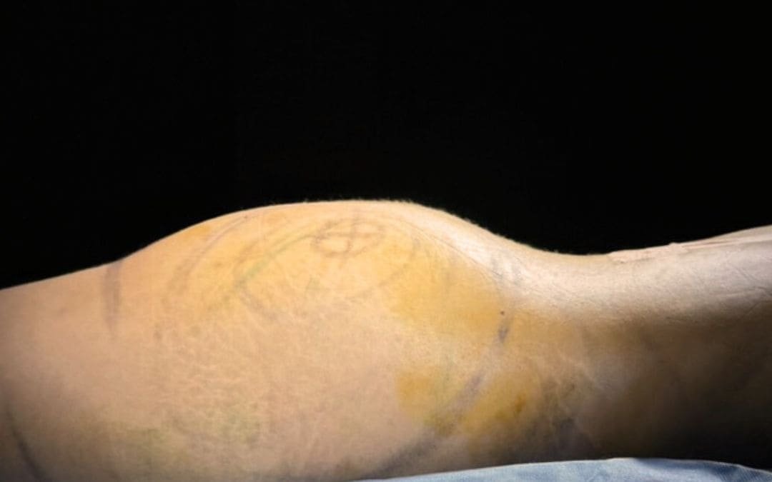 BBL Lipotransferencia a Gluteos Monterrey. Dr Garza Lizano. Cirujano Plastico en Monterrey Mexico (1)