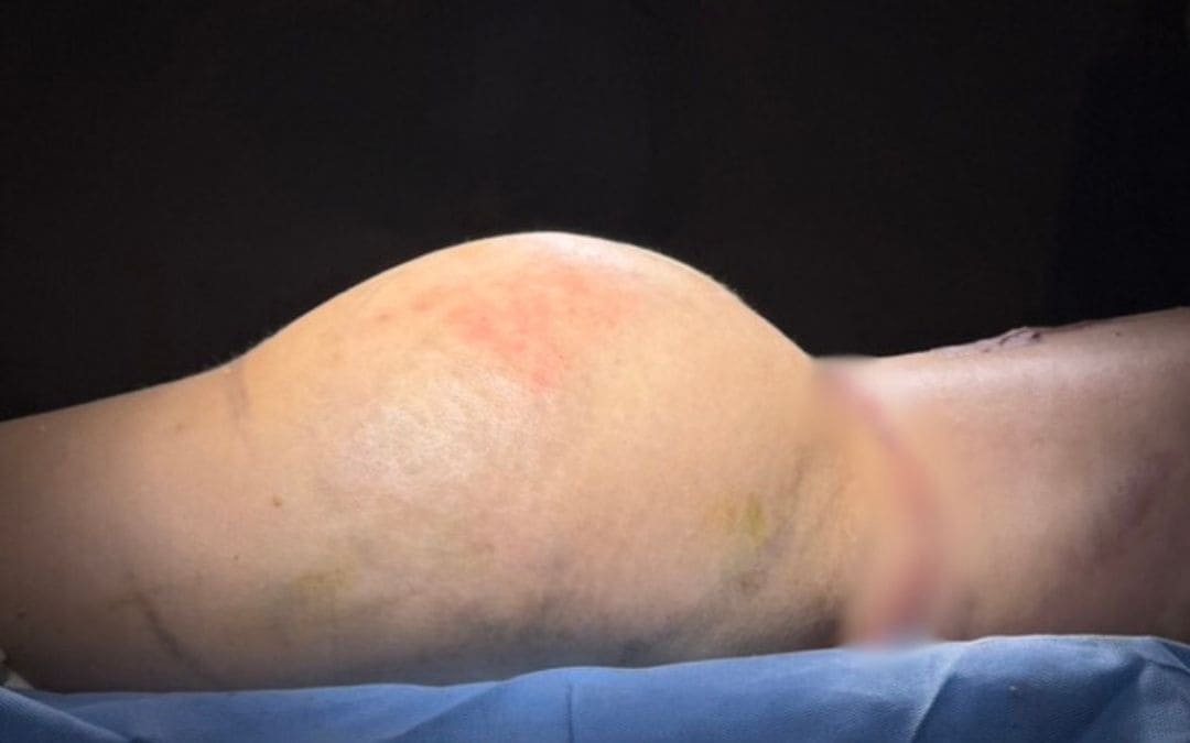 BBL Lipotransferencia a Gluteos Monterrey. Dr Garza Lizano. Cirujano Plastico en Monterrey Mexico (2)