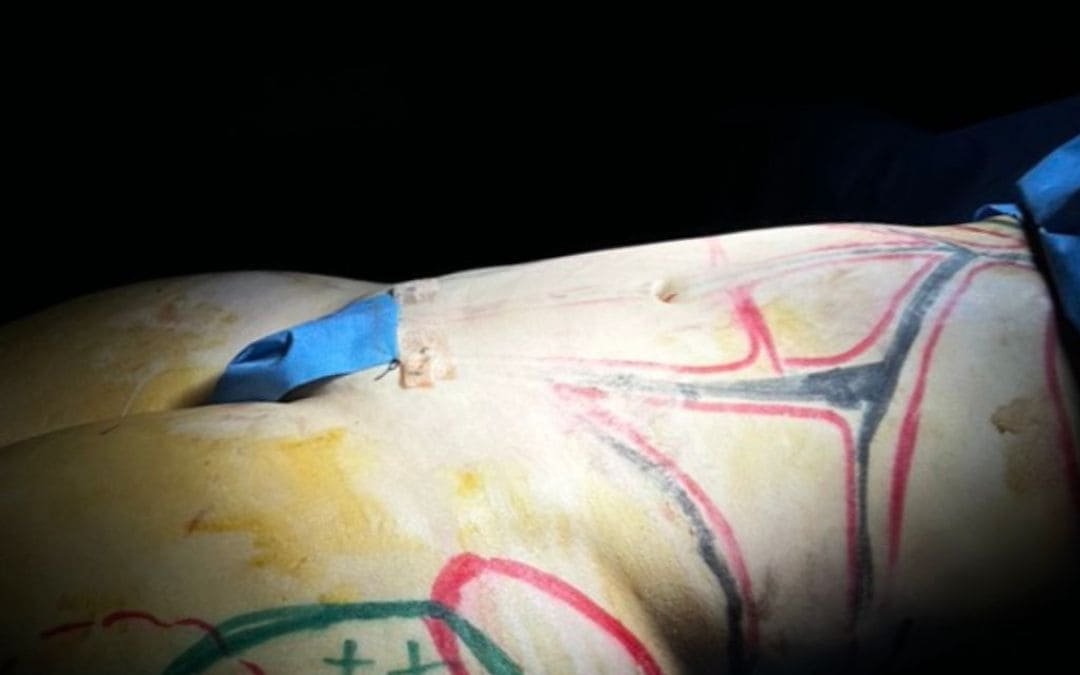 BBL Lipotransferencia a Gluteos Monterrey. Dr Garza Lizano. Cirujano Plastico en Monterrey Mexico (3)