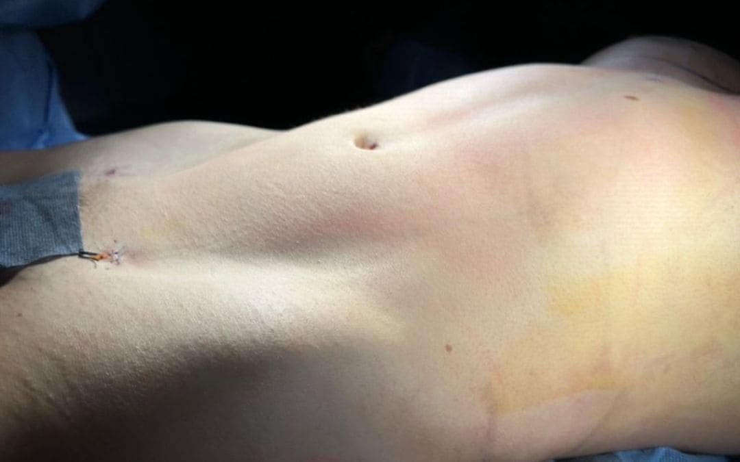 BBL Lipotransferencia a Gluteos Monterrey. Dr Garza Lizano. Cirujano Plastico en Monterrey Mexico (4)