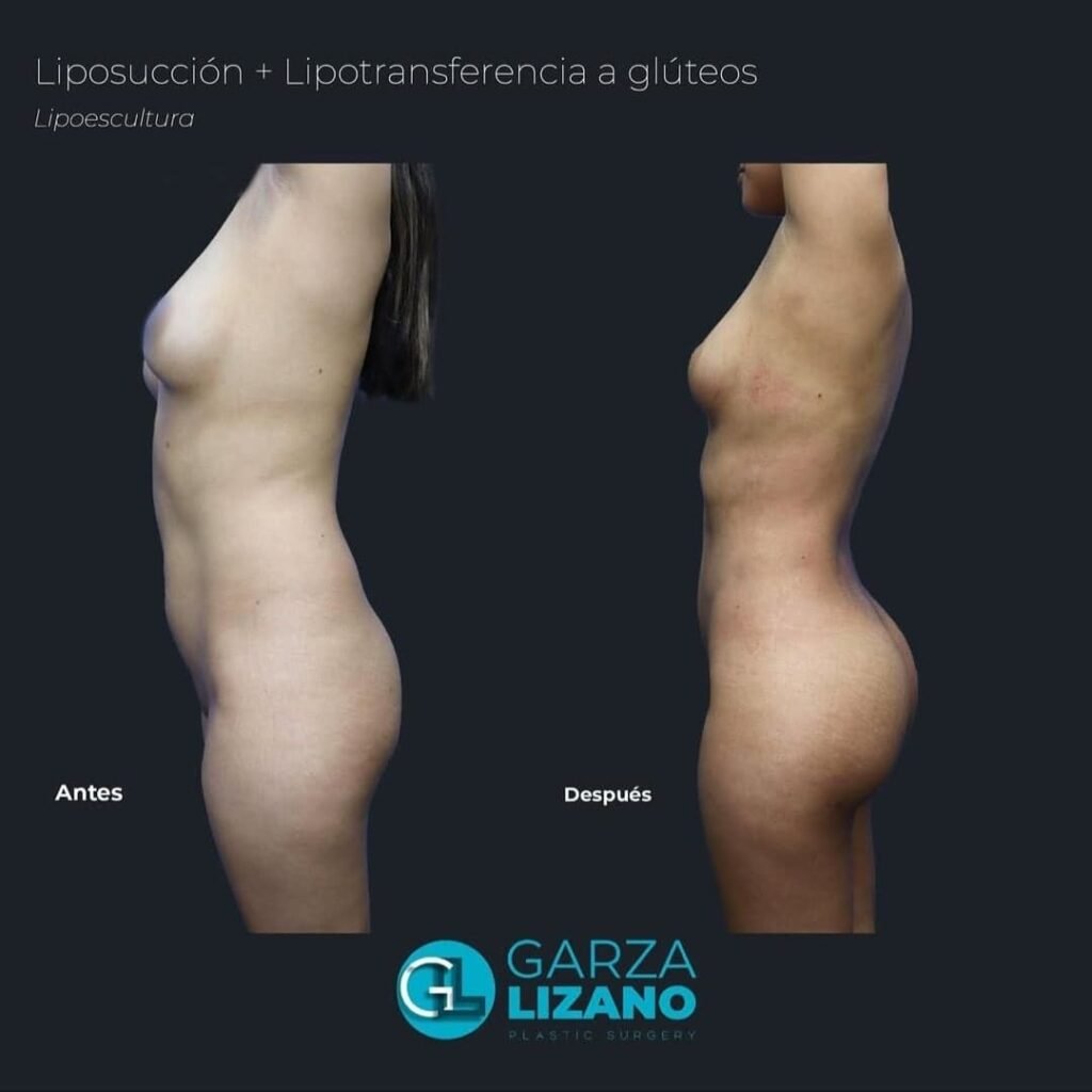 BBL Lipotransferencia a Glúteos Monterrey. Dr Garza Lizano. Cirujano Plastico en Monterrey Mexico (5)