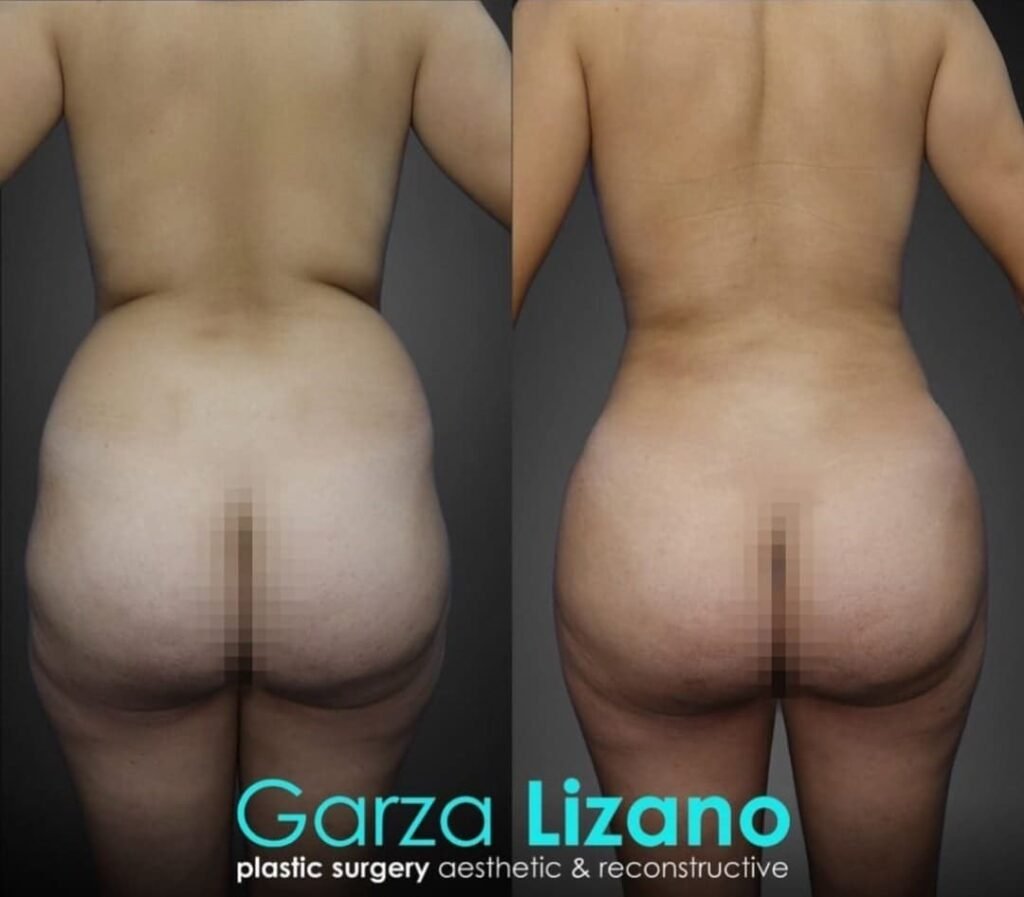 BBL Lipotransferencia a Glúteos Monterrey. Dr Garza Lizano. Cirujano Plastico en Monterrey Mexico (7)