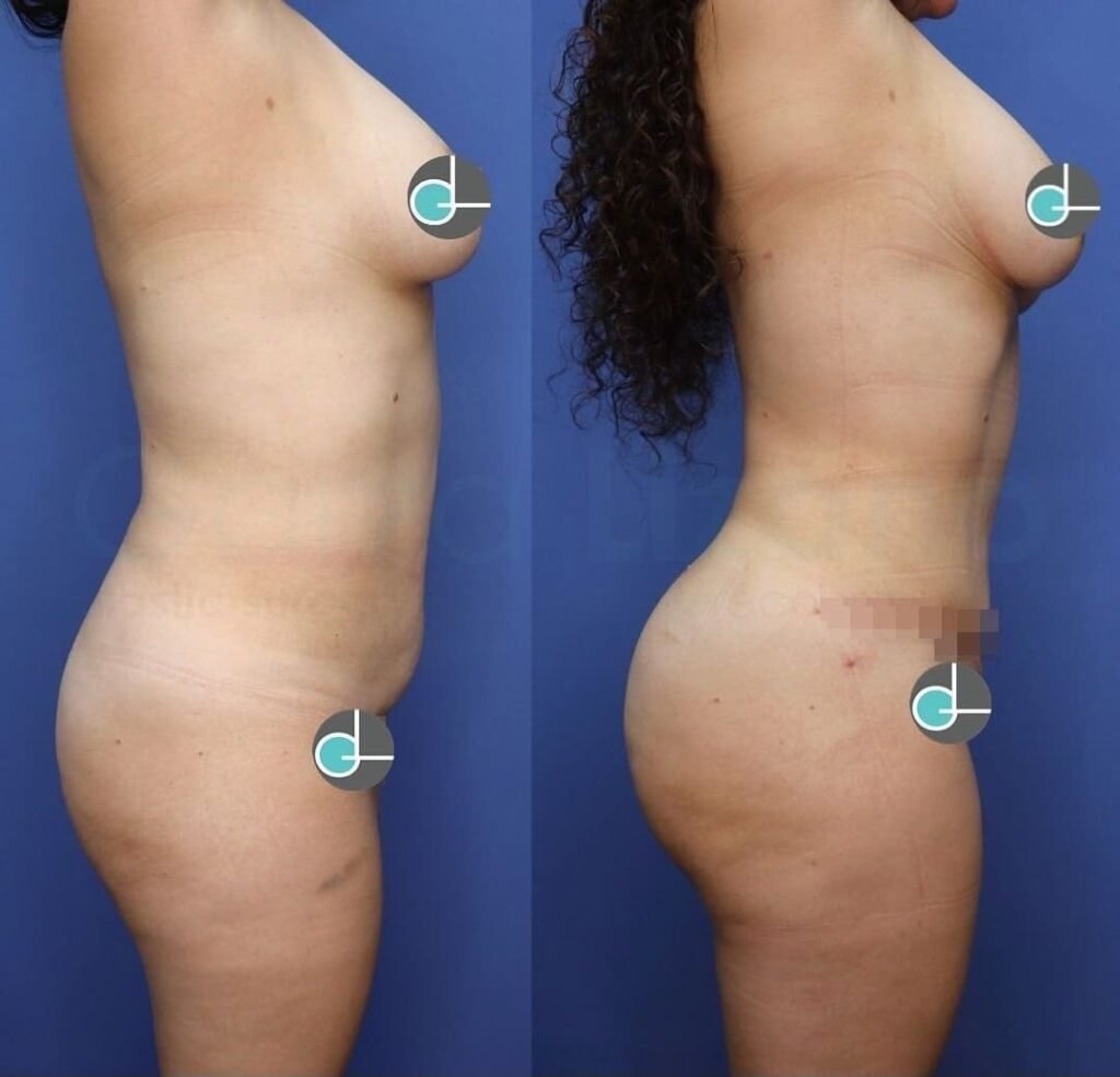 BBL Lipotransferencia a Glúteos Monterrey. Dr Garza Lizano. Cirujano Plastico en Monterrey Mexico (8)