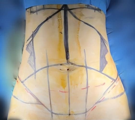 Mommy Makeover Monterrey. Dr Garza Lizano. Cirujano Plastico en Monterrey Mexico (1)