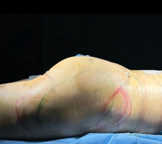 Mommy Makeover Monterrey. Dr Garza Lizano. Cirujano Plastico en Monterrey Mexico (3)