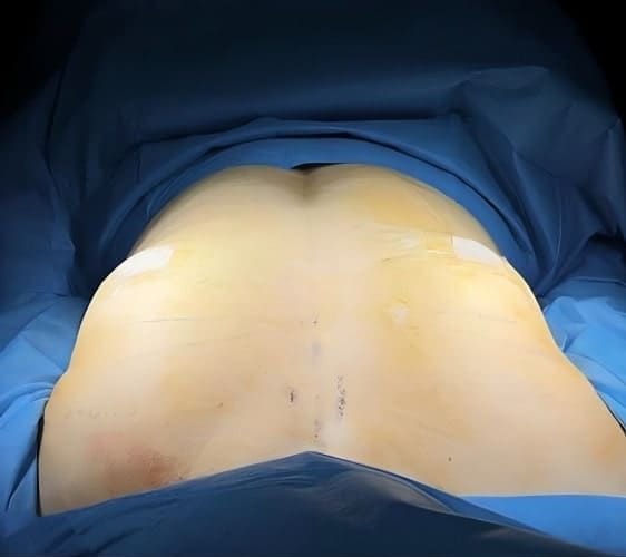 Mommy Makeover Monterrey. Dr Garza Lizano. Cirujano Plastico en Monterrey Mexico (5)