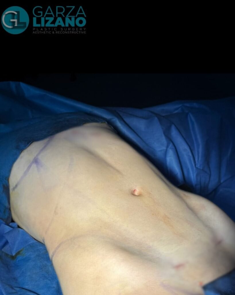 Mommy Makeover en Monterrey. Dr Garza Lizano . Cirujano Plastico en Monterrey (2)
