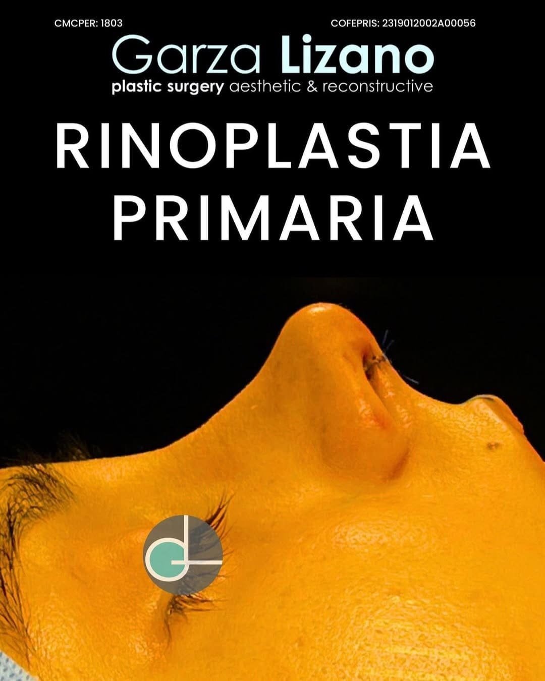 Rinoplastia Monterrey. Dr Garza Lizano. Cirujano Plastico en Monterrey (10)