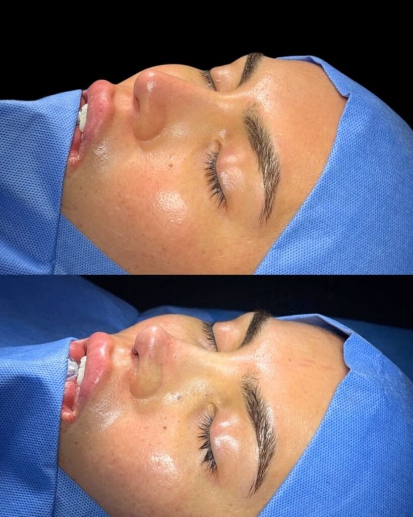 Rinoplastia Monterrey. Dr Garza Lizano. Cirujano Plastico en Monterrey (3)