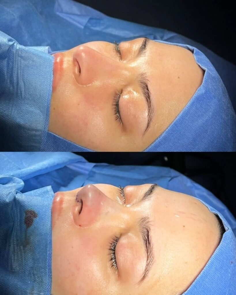 Rinoplastia Monterrey. Dr Garza Lizano. Cirujano Plastico en Monterrey (3)