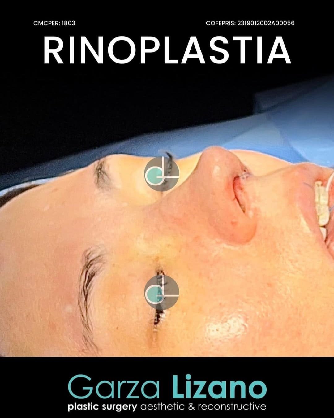 Rinoplastia Monterrey. Dr Garza Lizano. Cirujano Plastico en Monterrey (5)