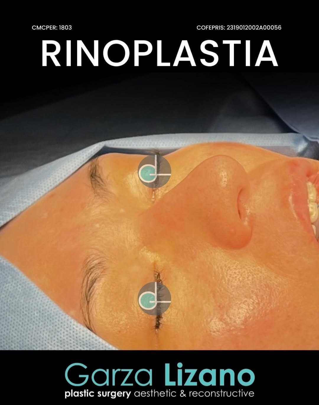 Rinoplastia Monterrey. Dr Garza Lizano. Cirujano Plastico en Monterrey (6)