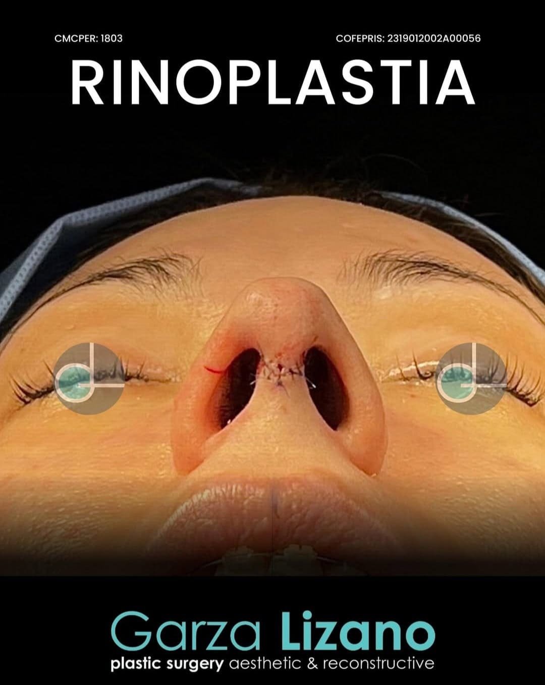 Rinoplastia Monterrey. Dr Garza Lizano. Cirujano Plastico en Monterrey (7)